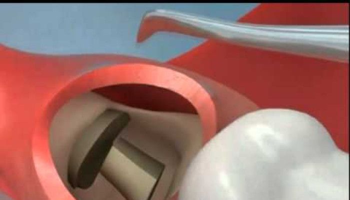 ICE,dental,health,educational,wisdom,teeeth,extraction,surgery,dentist,dr,joseph,mcmurray