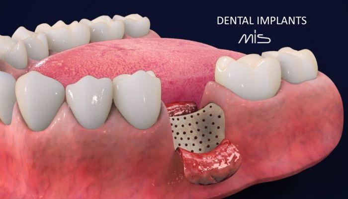 dental,dental implants,dental implants guide,3d animation,dental implants full set of teeth,dental implants animation,dental implant procedure front teeth,dental implant procedure animation,3d animation tutorial,3d animation video,teeth surgery,teeth surg